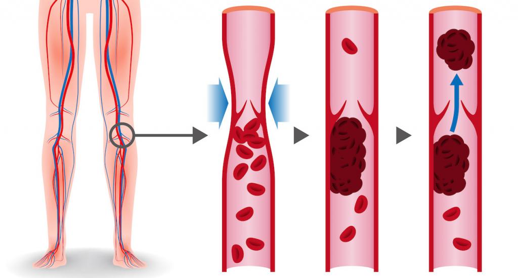 Возникновение тромбоза на ноге