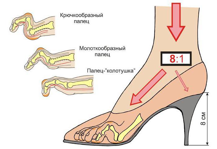 молоткообразные пальцы на ногах