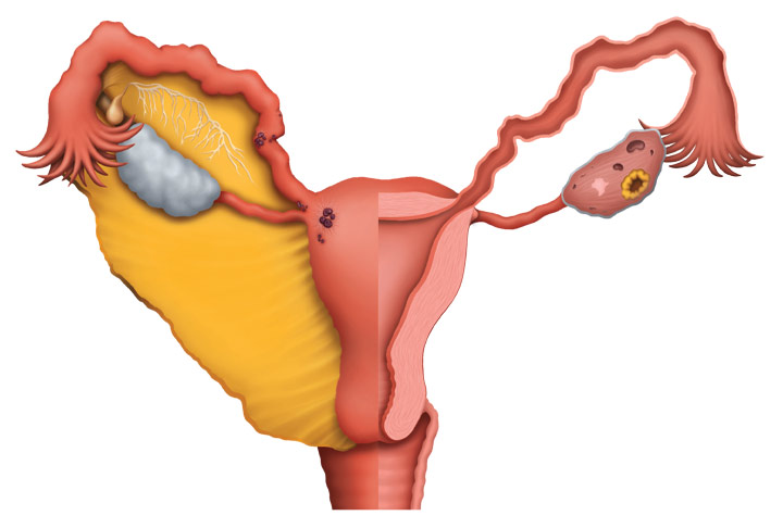 Endometriosis picture