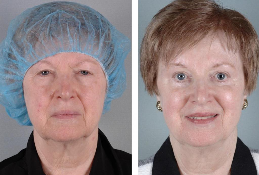 До и после операции на глаза