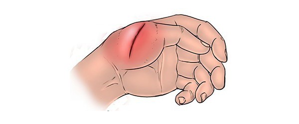 Колото-резаная рана грудной клетки