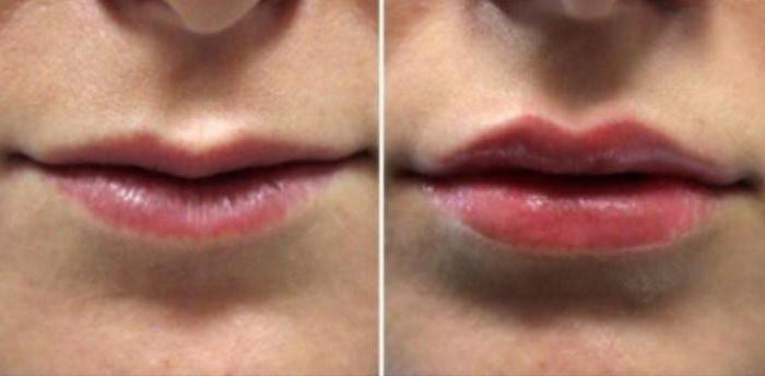 Губы с гиалуроновой кислотой до и после фото