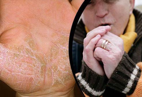Аллергия кожи рук на холод фото thumbnail