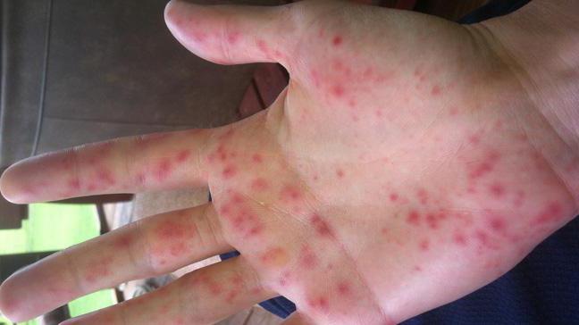 Аллергия на ветер у ребенка на руках thumbnail