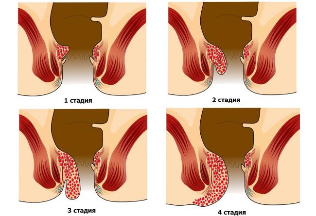 симптомы геморроя по стадиям