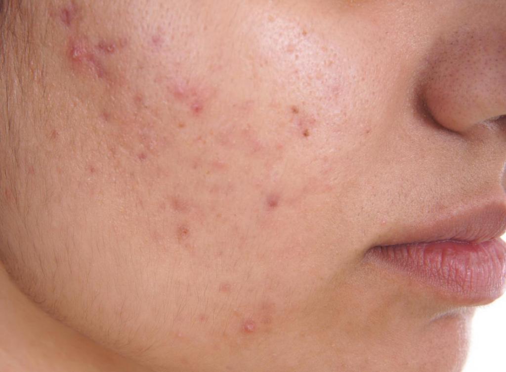 Acne vulgaris