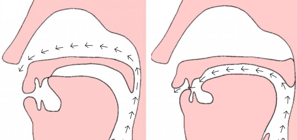 Закрытая и открытая ринолалия