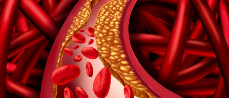 Vascular atherosclerosis