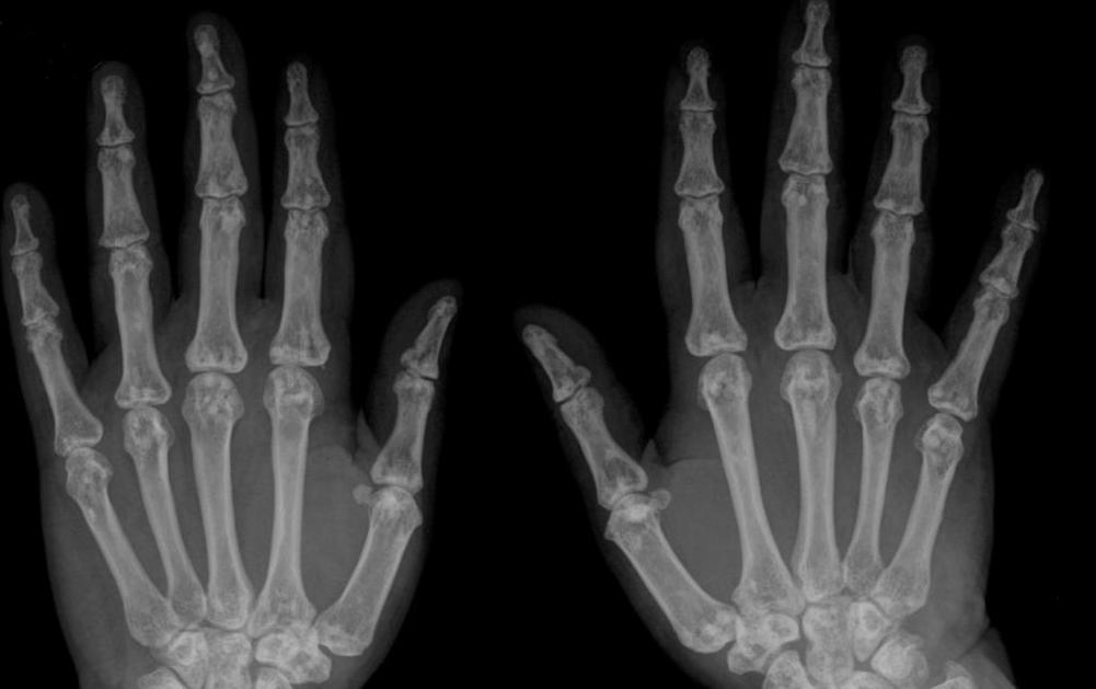 Finger x-ray