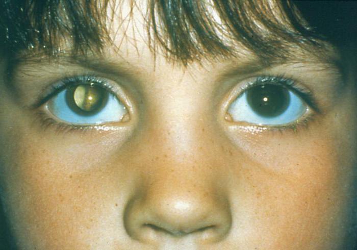 катаракта причины симптомы
