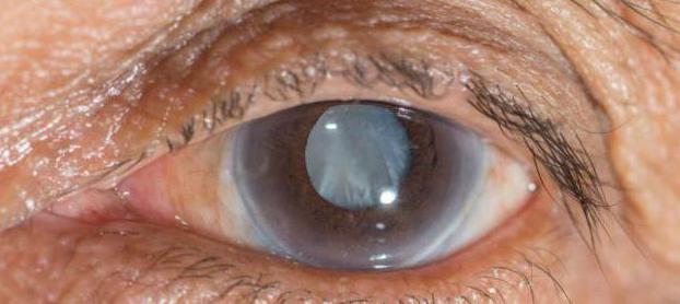 лечение начальной стадии катаракты