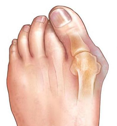 Лечение согнутых пальцев ног thumbnail