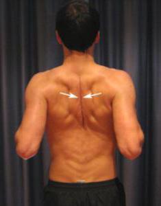 ромбовидная мышца спины