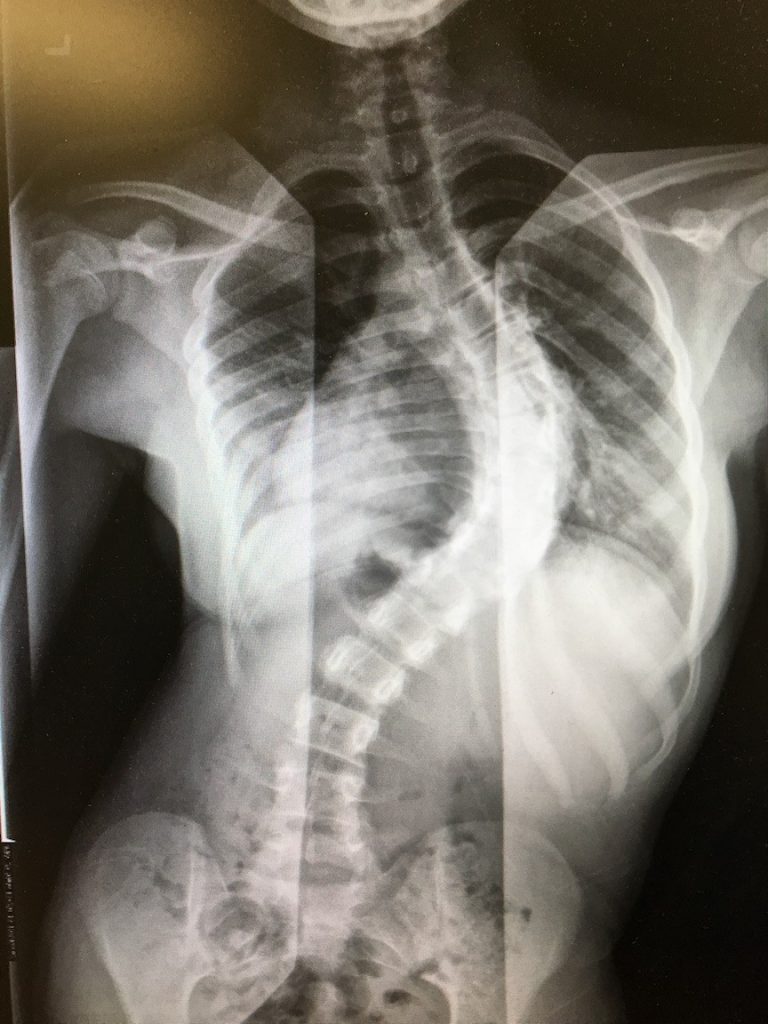 Рентген спины человека