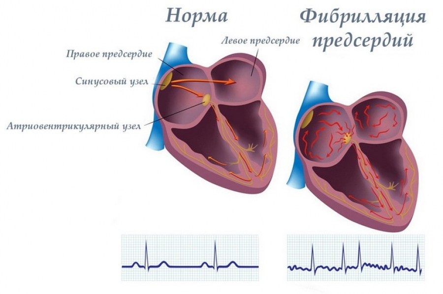 Фибрилляция предсердий