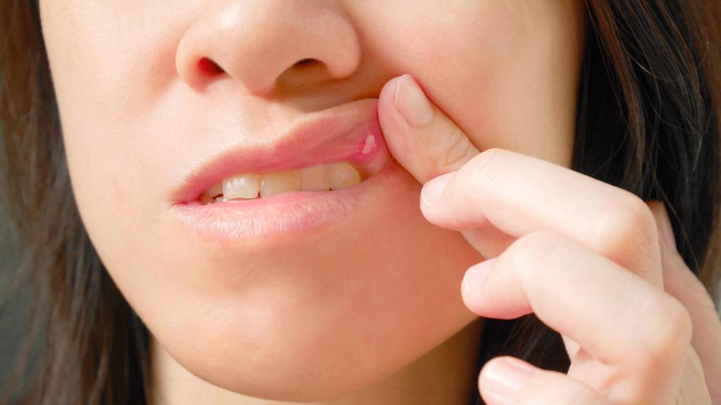 язвы на внутренней стороне губы как лечить