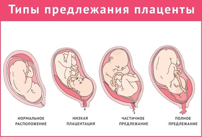 неправильное предлежание плаценты