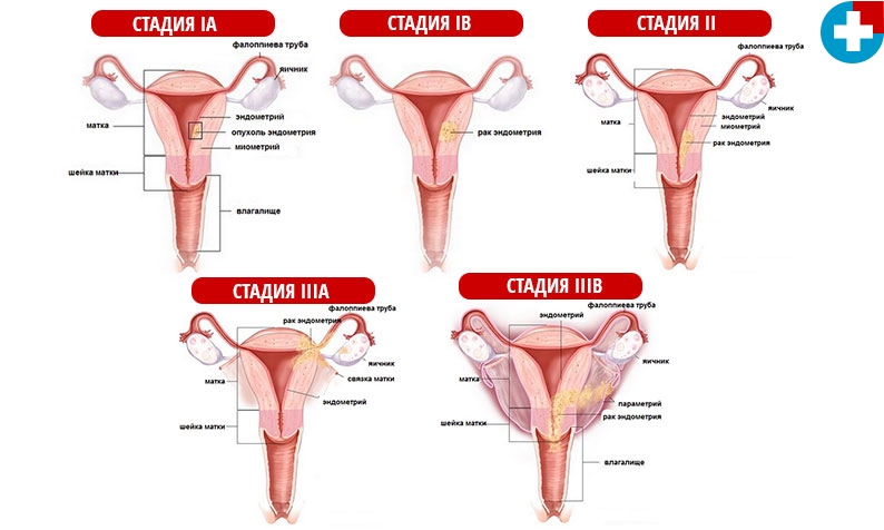 Cancer stages