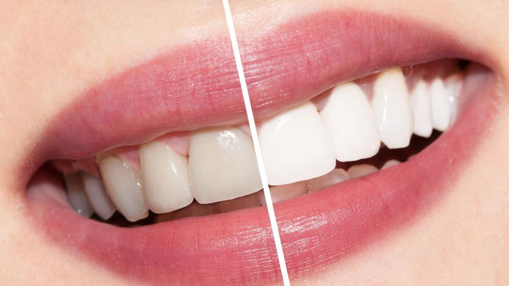 минусы лазерного отбеливания зубов