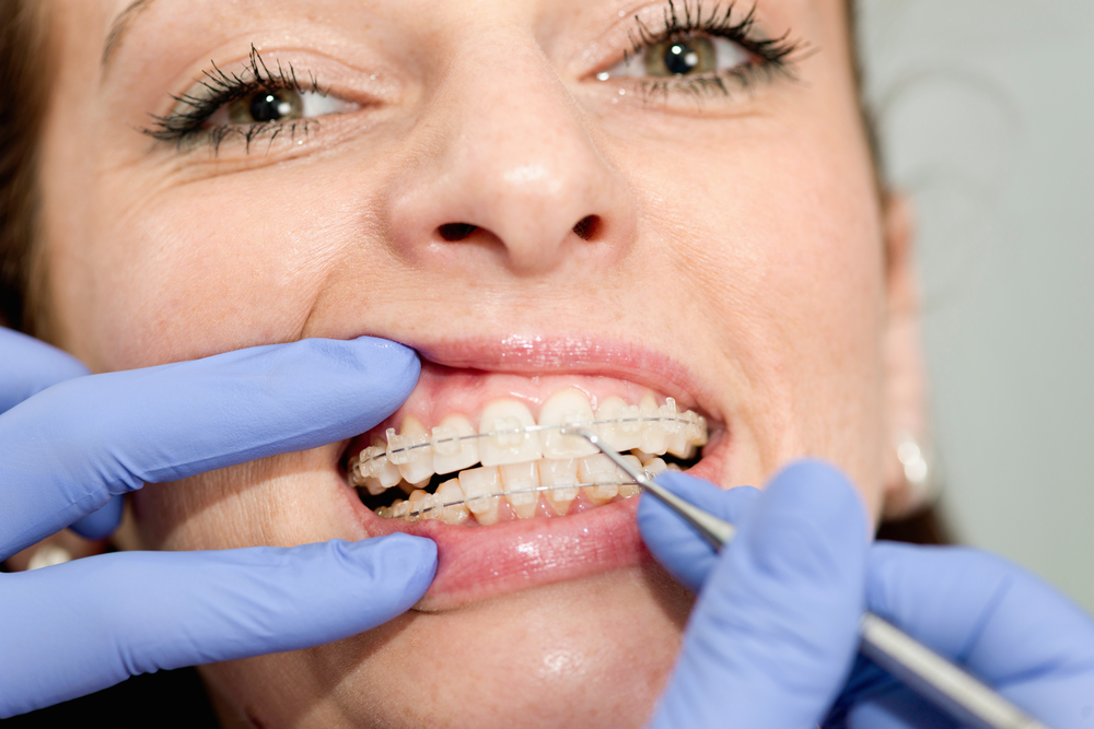 неровные зубы как исправить