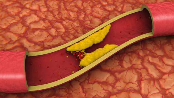 Анализ крови на холестерин сдают на голодный желудок thumbnail