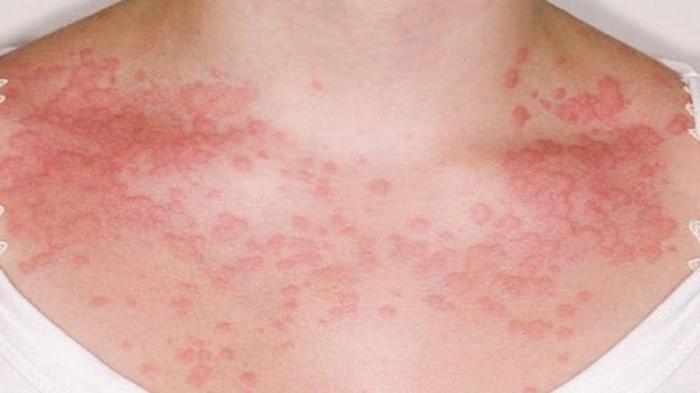аллергия на сладкое у взрослых симптомы