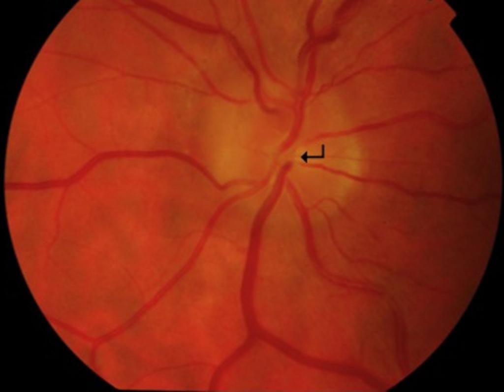 optic nerve edema