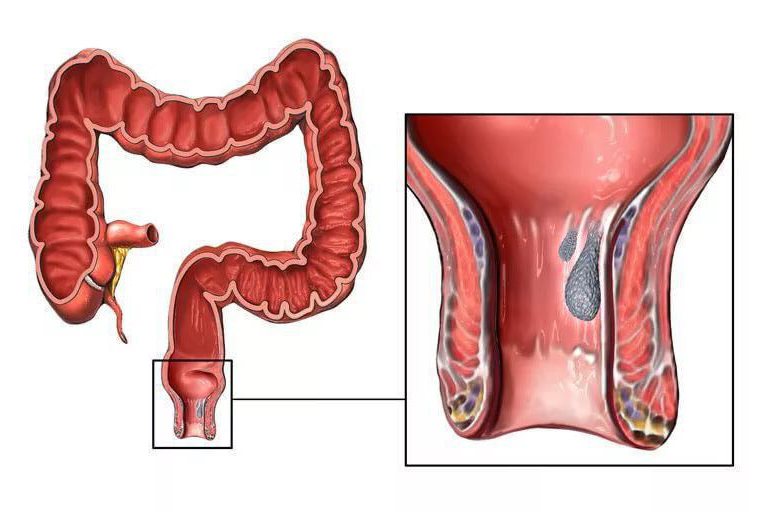 Геморройные участки