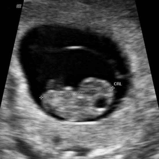 Фото эмбриона на 9 неделе беременности фото