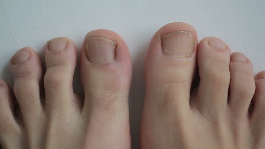 На ногти на ногах фото до и после