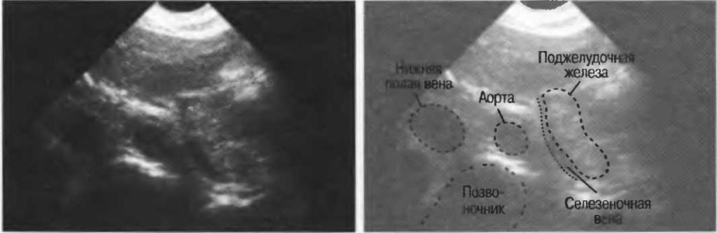 Повышение эхогенности поджелудочной железы