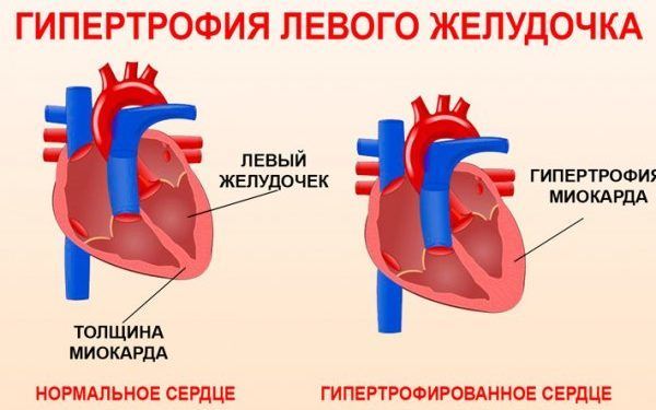 гипертрофия миокарда левого желудочка сердца лечение