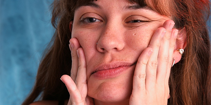неврит лицевого нерва лечение в домашних условиях