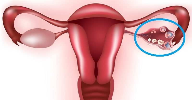 mucinous cyst of the right ovary treatment