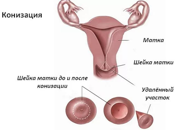 Послеоперационный период после конизации шейки матки: особенности реабилитации