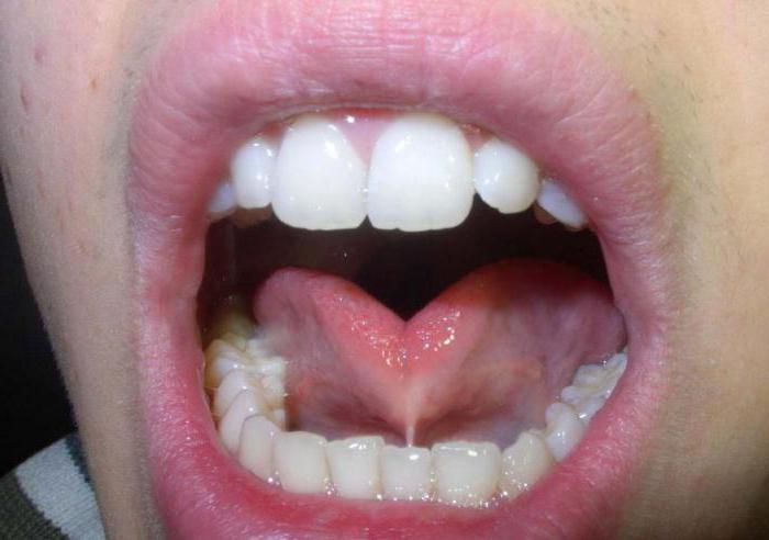Как выглядит рак полости рта фото начальная стадия