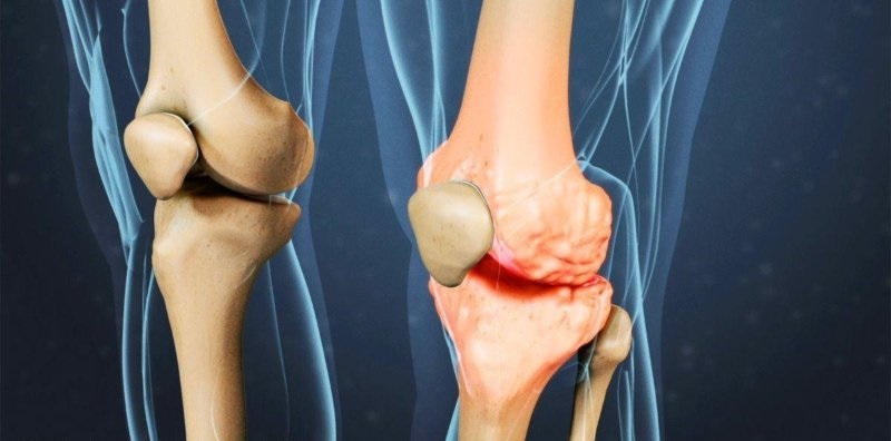 лечение артрита коленного сустава лекарства
