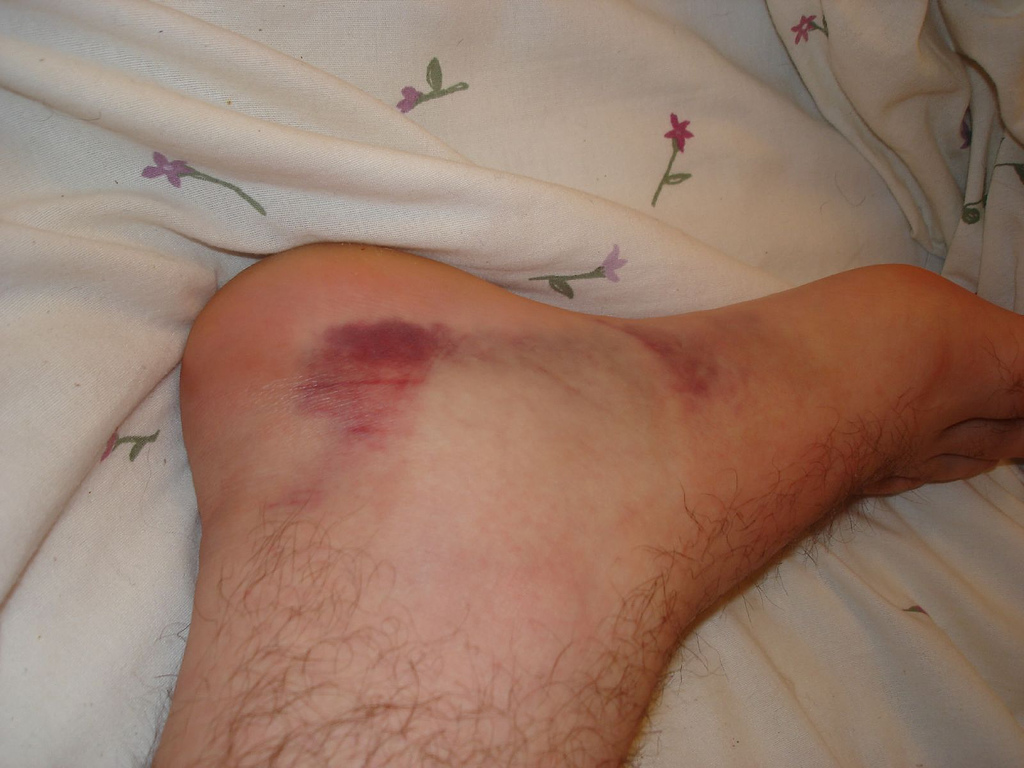 The appearance of a tumor with an ankle sprain