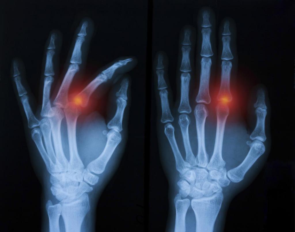 Диагностика перелома руки при помощи рентгена