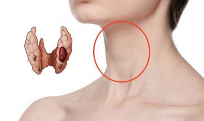 диффузные изменения щитовидной железы