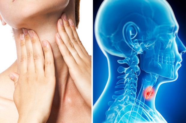 рак горла симптомы у женщин