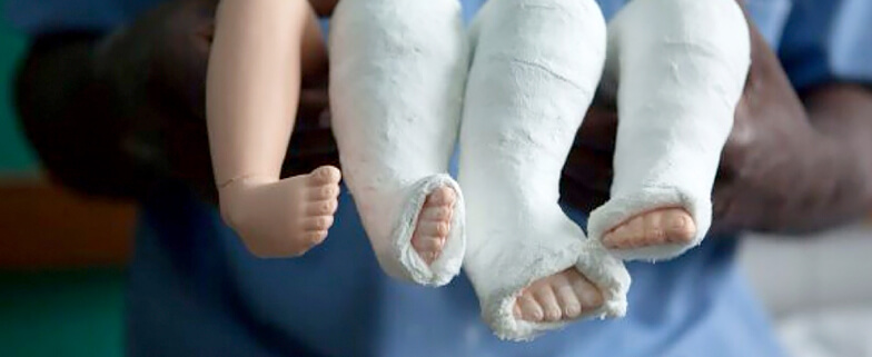 The foot of the baby is fixed in a cast