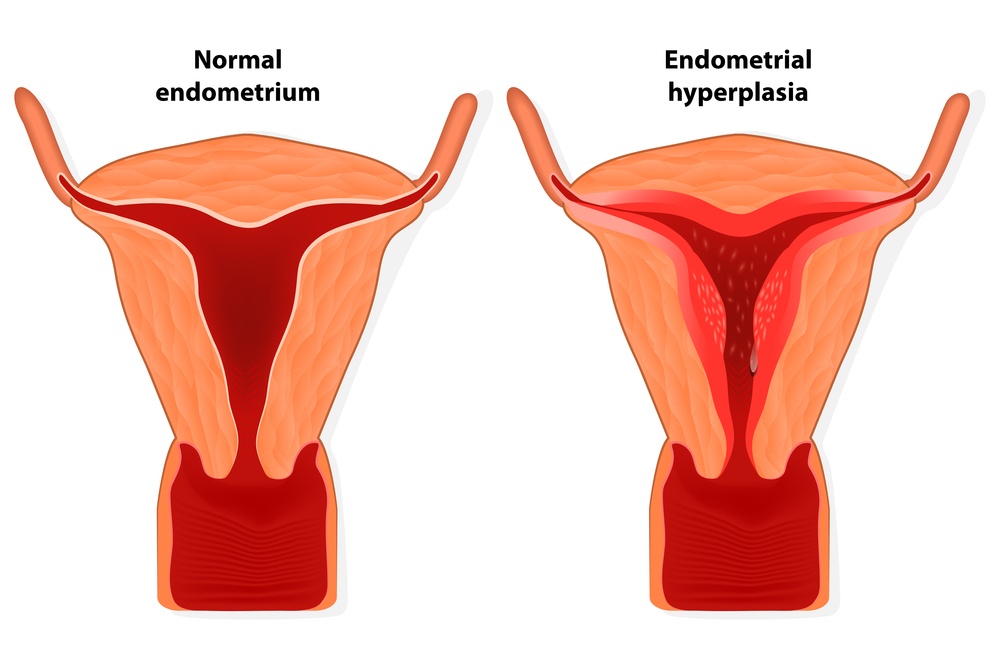 Nutrition for uterine endometriosis