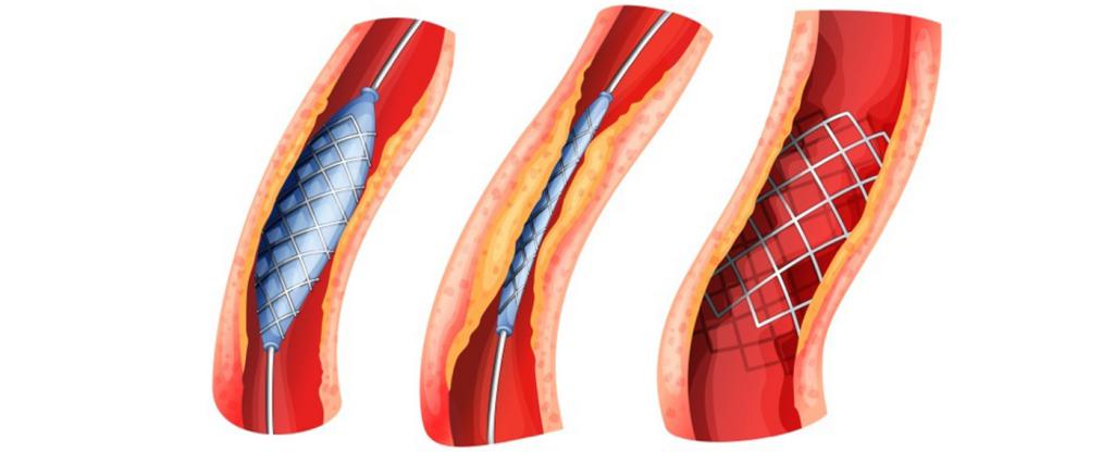 Peripheral Artery Examination