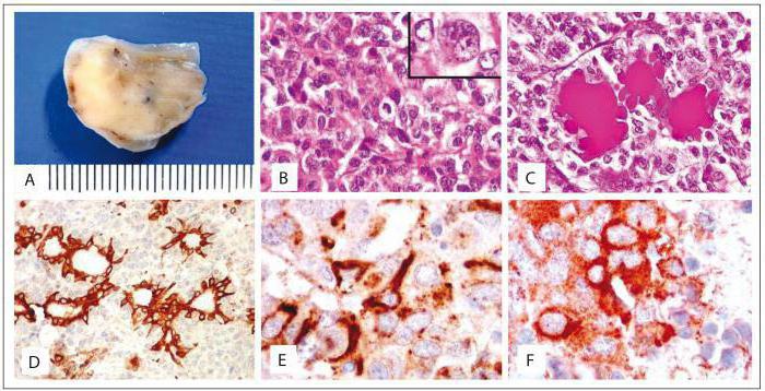 pituitary adenoma histology