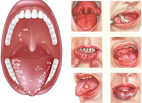 стоматита во рту
