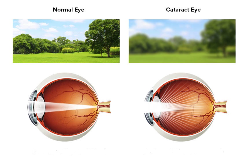 катаракта глаза как лечат