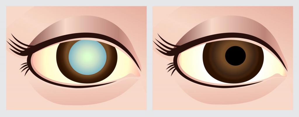 катаракта глаза операция