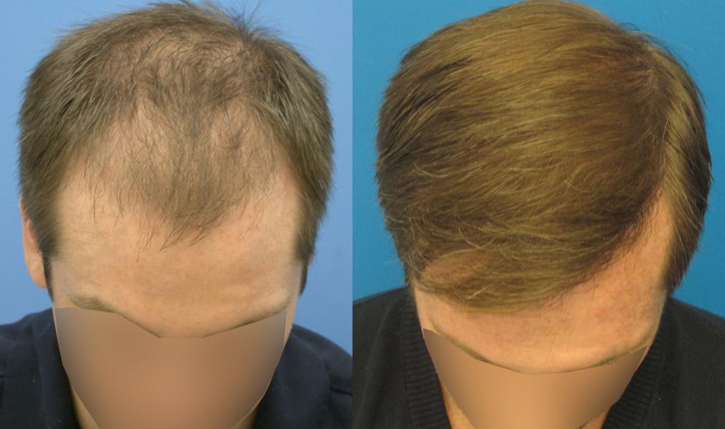 diffuse alopecia hair transplantation