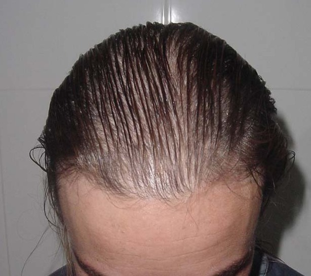 diffuse alopecia in women treatment